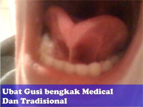 Obat Gusi Bengkak Dan Obat Tradisional